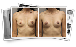 Breast Surgery - Implant Replacement Results Thousand Oaks