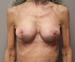 Breast Implant Replacement