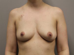 Nipple-sparing Mastectomy Reconstruction