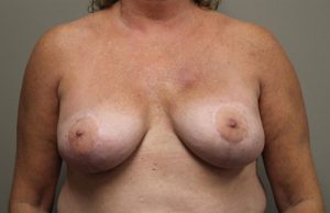 Nipple-sparing Mastectomy Reconstruction
