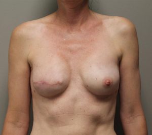 Reconstruction with Implants