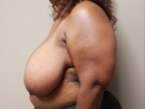 Breast Reduction & Lift