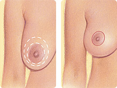 Breast Lift After Surgery Illustration