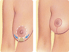 Moderate Breast Lift Illustration