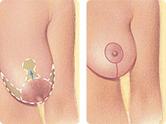 Larger Breast Lift Illustration