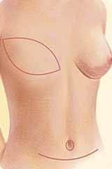 DIEP Flaps Los Angeles & Thousand Oaks  Institute for Advanced Breast  Reconstruction