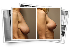 Breast Surgery - Breast Lift Results Thousand Oaks