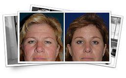 Blond lady before surgery and a lady with brown hair after a brow lift surgery Brow Lift Thousand Oaks