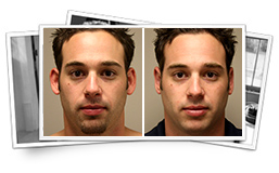 Man with even ears and a man with uneven ears Ear Reshaping Result Thousand Oaks,