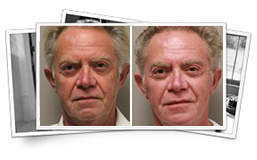 Man Before Face lift and Man after Face lift Face lift Results Thousand Oaks