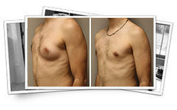 Breast Surgery - Male Breast Reduction Results Thousand Oaks