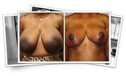 Breast Surgery - Breast Reduction Results Thousand Oaks
