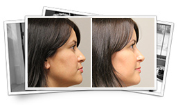 Front rhino result Nose Reshaping Result Thousand Oaks