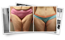 Thigh Lift Results Thousand Oaks
