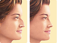 Before and After Rhinoplasty Effects
