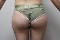 Buttocks (Brazilian Butt Lift )