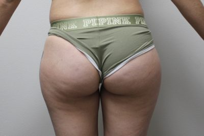 Buttocks (Brazilian Butt Lift )
