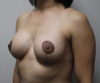 Breast Augmentation & Lift