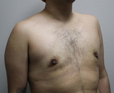 Trans-Male Top Surgery