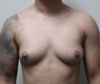 Trans-Male Top Surgery