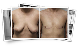 Top Surgery before and after photo by Dr. Kryger in Thousand Oaks, CA