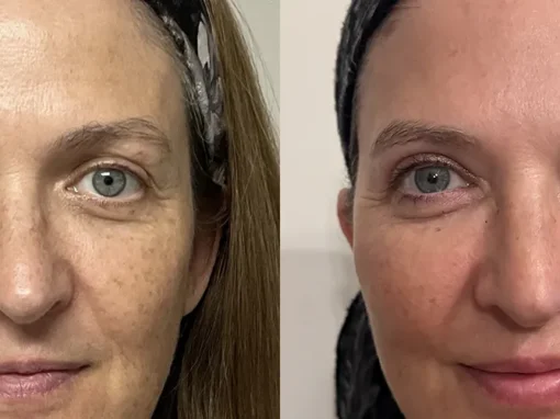 blepharoplasty fat grafting before and after photos by kryger institute of plastic surgery